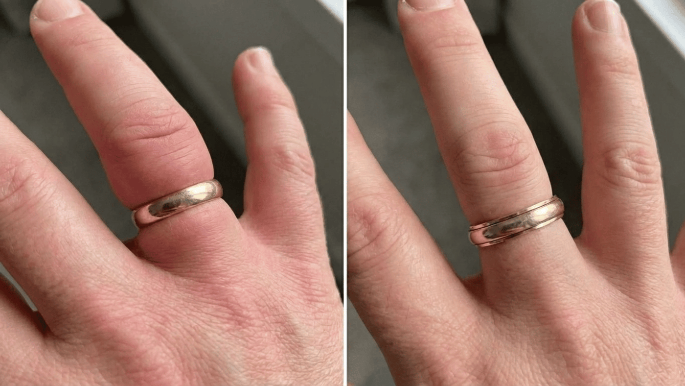 Doigt avec bague avant / après